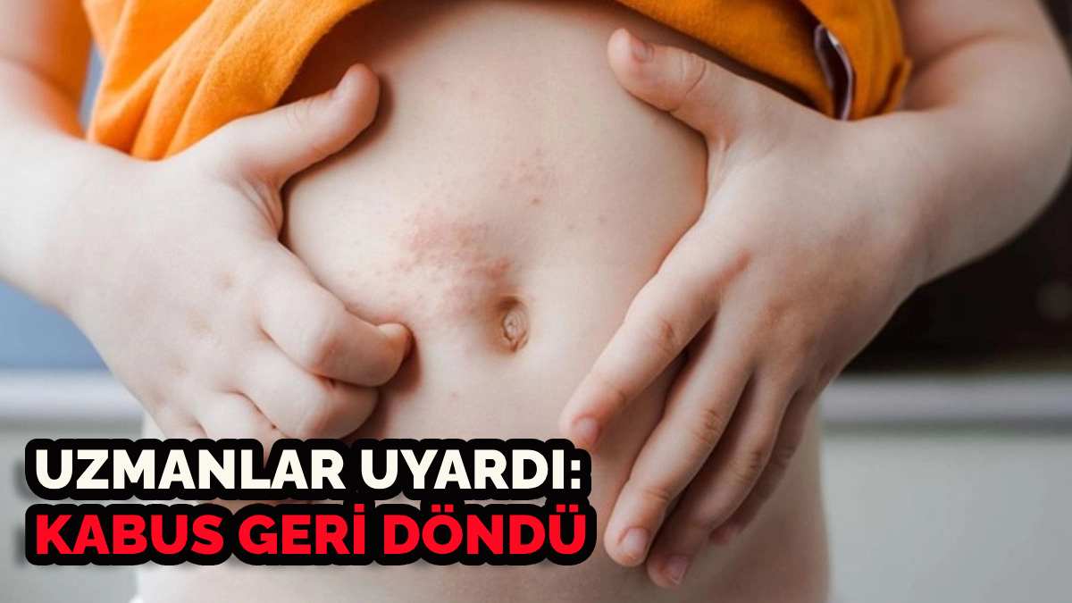 Kabus yeniden hortladı! Gece gelen kaşıntılara dikkat, uzmanlar uyardı: Vakalar hızla artıyor