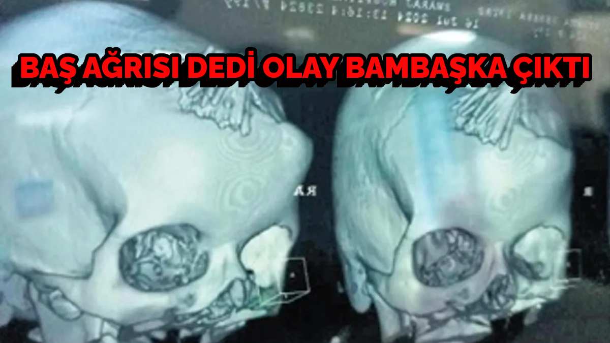 Baş ağrısıyla hastaneye koştu, doktorlar görünce şok oldu! Başından 77 tane iğne çıkarıldı