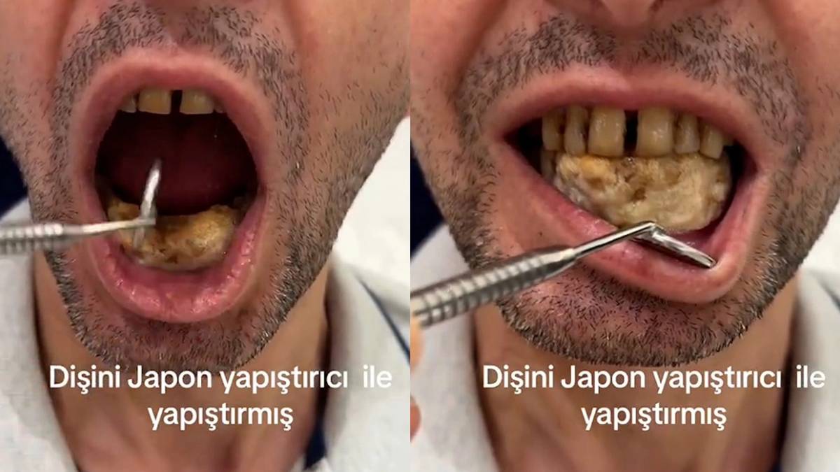 Bu da olur mu demeyin! Japon yapıştırıcısıyla ağzına diş yaptı: Görenlerin midesi kalktı