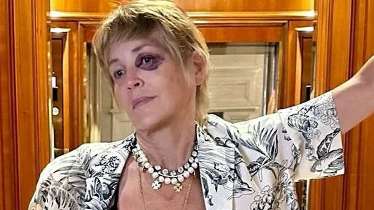 Sharon Stone’un gözüne ne oldu?