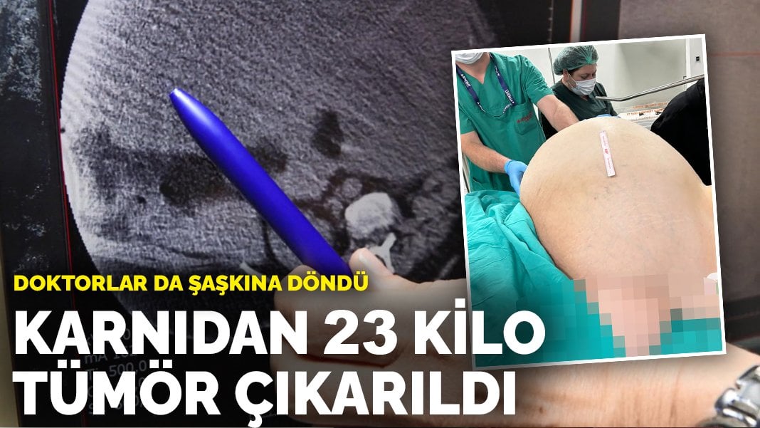 Karından 23 kilo tümör çıkarıldı: Doktorlar da şaşkına döndü