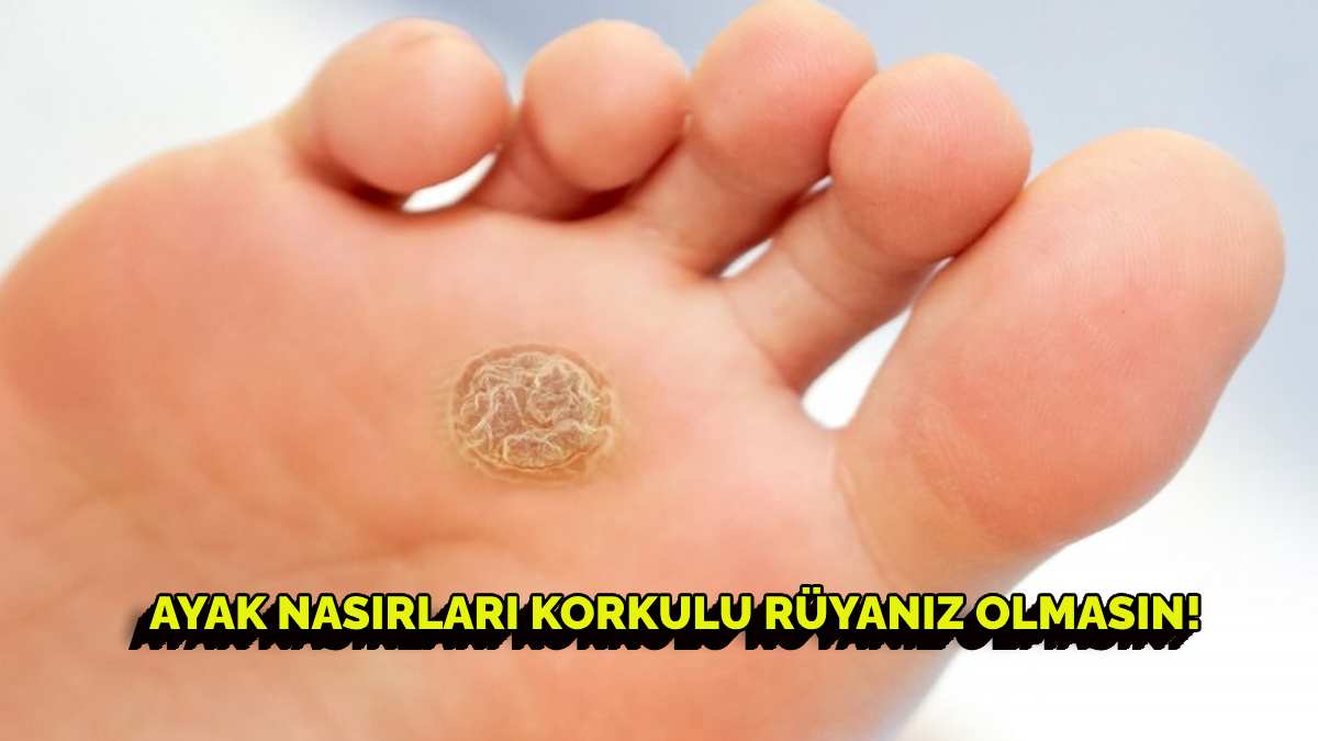 Ayak nasırlarından kurtulmak için en etkili yöntemler nelerdir? Kurtulmak hiç bu kadar kolay olmamıştı