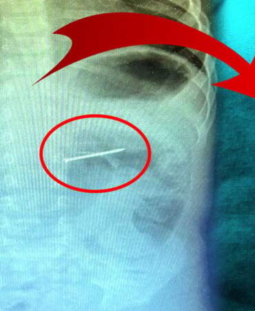 Doktorlar mucizeyi gerçekleştirdi: Çivi yutan bebek kurtarıldı! Ailesi öldü öldü dirildi