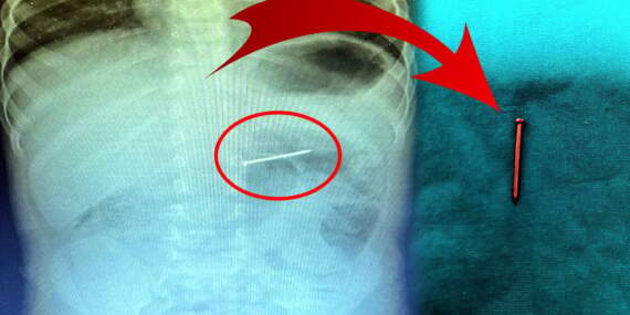 Doktorlar mucizeyi gerçekleştirdi: Çivi yutan bebek kurtarıldı! Ailesi öldü öldü dirildi