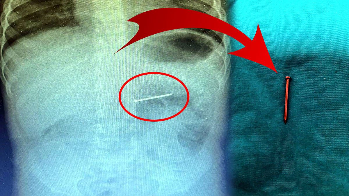 Doktorlar mucizeyi gerçekleştirdi: Çivi yutan bebek kurtarıldı! Ailesi öldü öldü dirildi