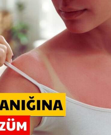 Cildiniz güneşte yandıysa panik yapmayın! Bu karışımı sürün, yanık ve kızarıklık anında azalıyor!