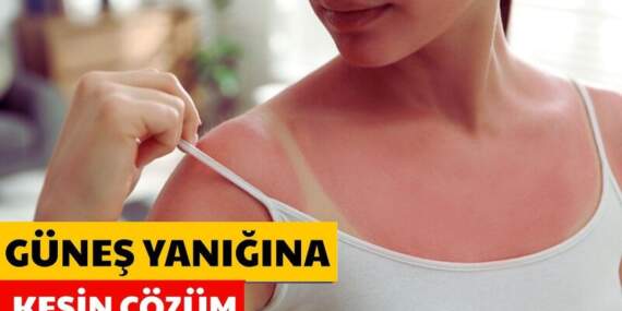 Cildiniz güneşte yandıysa panik yapmayın! Bu karışımı sürün, yanık ve kızarıklık anında azalıyor!