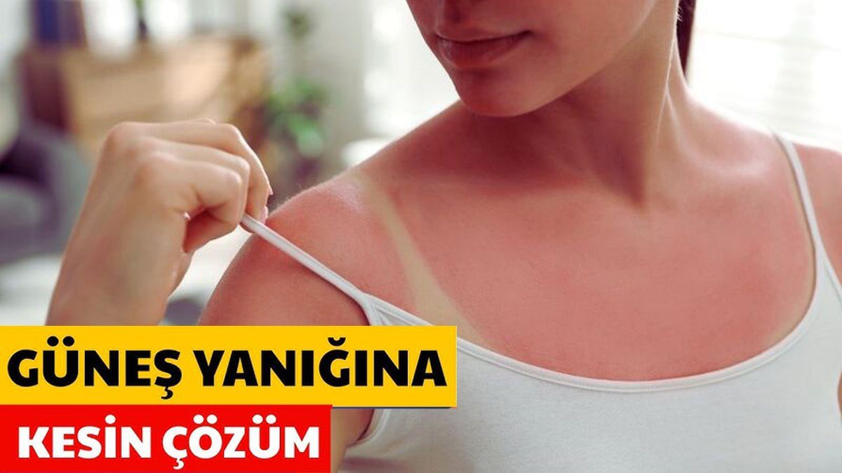 Cildiniz güneşte yandıysa panik yapmayın! Bu karışımı sürün, yanık ve kızarıklık anında azalıyor!