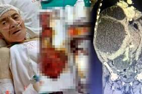 Karnından 90 santimetrelik kedi-köpek kisti çıkarıldı! Karın şişliğiyle gitti, doktorlar da şaştı kaldı