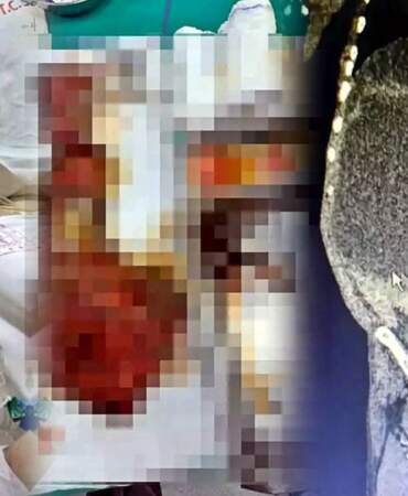 Karnından 90 santimetrelik kedi-köpek kisti çıkarıldı! Karın şişliğiyle gitti, doktorlar da şaştı kaldı