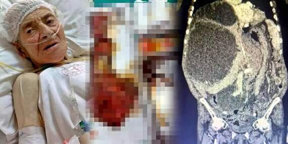 Karnından 90 santimetrelik kedi-köpek kisti çıkarıldı! Karın şişliğiyle gitti, doktorlar da şaştı kaldı