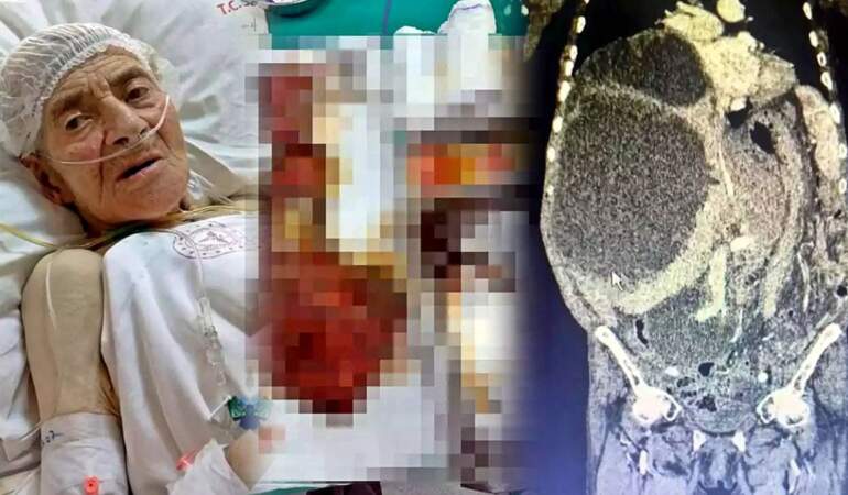 Karnından 90 santimetrelik kedi-köpek kisti çıkarıldı! Karın şişliğiyle gitti, doktorlar da şaştı kaldı