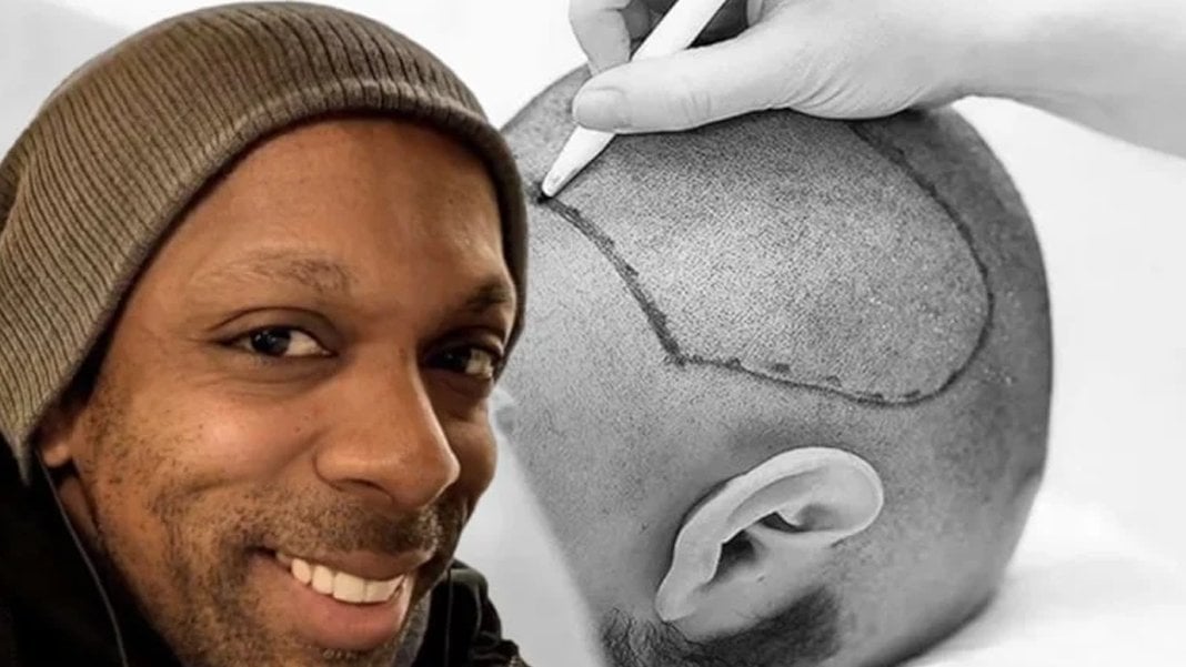 İstanbul’da estetik operasyonun ardından ölüm: Saç ekimi için geldi, hayatını kaybetti