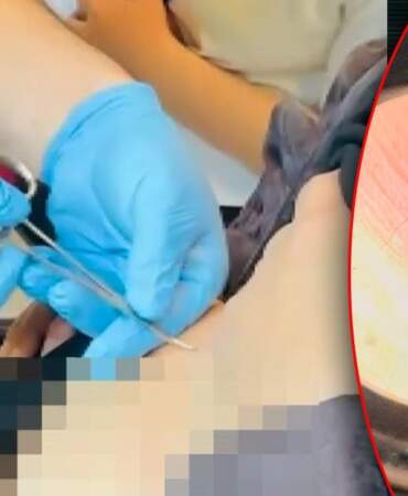 Halsizlik Şikayetiyle Hastaneye Gitti, Karnından Çıkanla Şoke Oldu