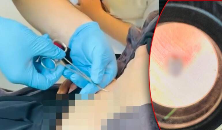 Halsizlik Şikayetiyle Hastaneye Gitti, Karnından Çıkanla Şoke Oldu