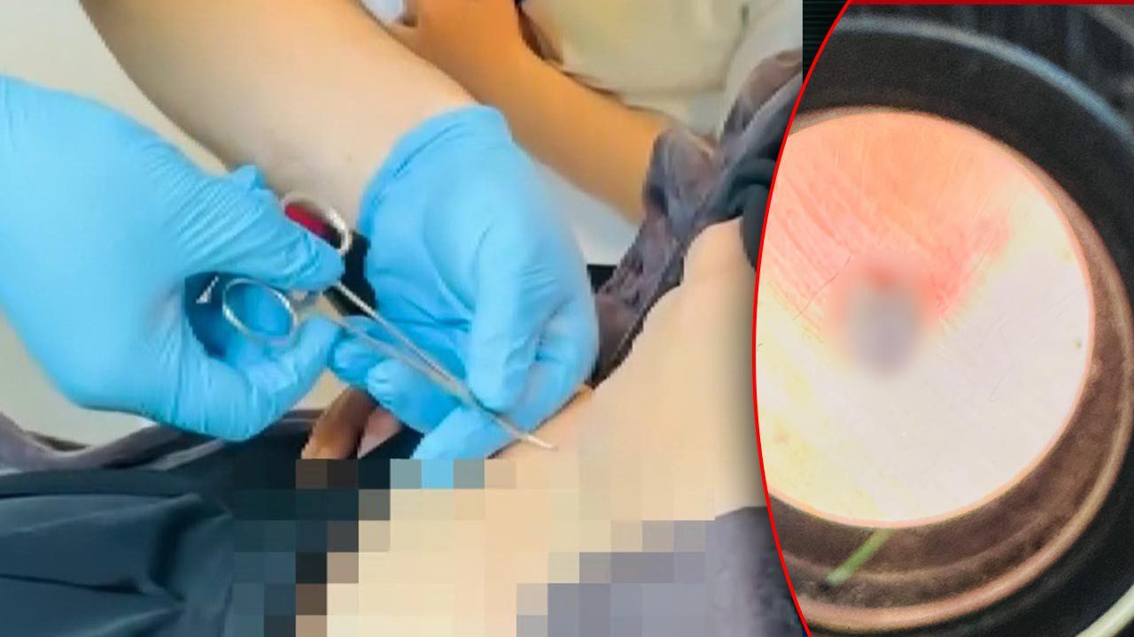 Halsizlik Şikayetiyle Hastaneye Gitti, Karnından Çıkanla Şoke Oldu