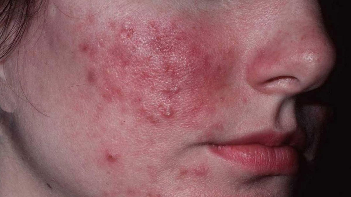 Alerji sandığımız o durum aslında bambaşka bir hastalığın belirtisiymiş! Bu yiyecekler ve alışkanlıklar hastalığı tetikliyor