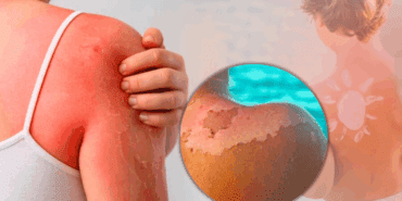 250 Liralık Kabus! Güneş Kreminin Alternatifinde Gizli Tehlike, Vakalar Artabilir