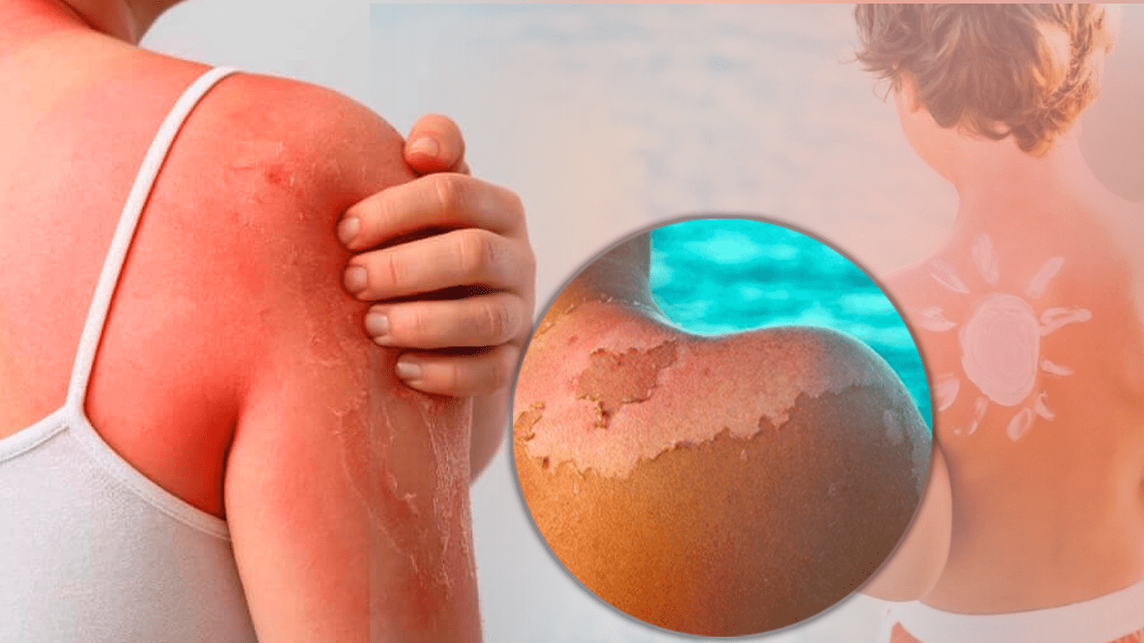 250 Liralık Kabus! Güneş Kreminin Alternatifinde Gizli Tehlike, Vakalar Artabilir