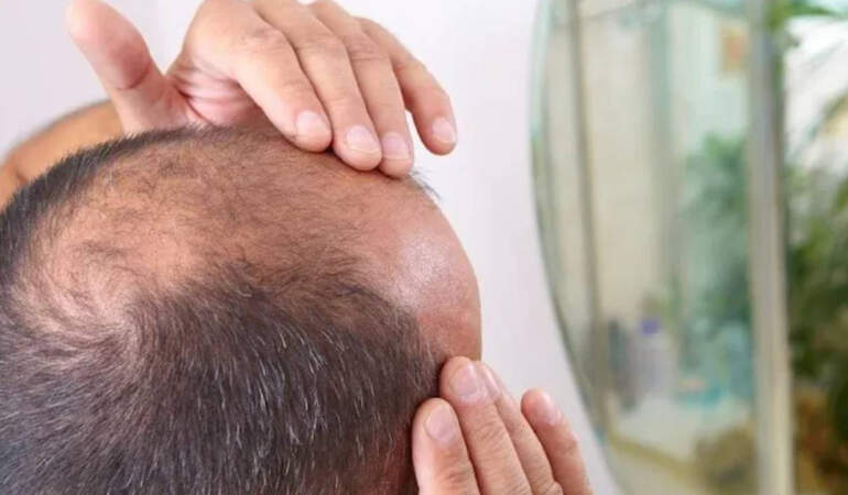 İçmeden Önce Bir Kez Daha Düşünün! Bu İçecekler Kel Yapıyor