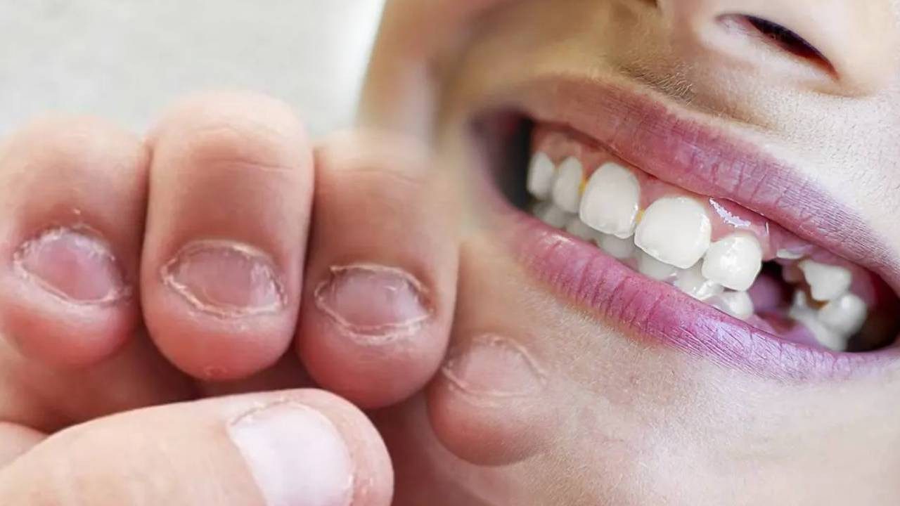 Türkiye’de Her 3 Kişiden 1’inde Görülüyor! Tırnaklardan Başlıyor, Diş Köklerini Eritiyor