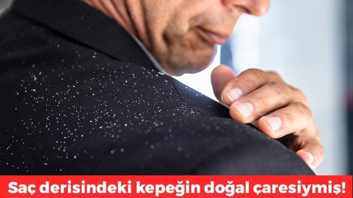 Kepek sorunu tarihe karışıyor! Kimyasal ürünlere veda edenlerin sırrı ortaya çıktı