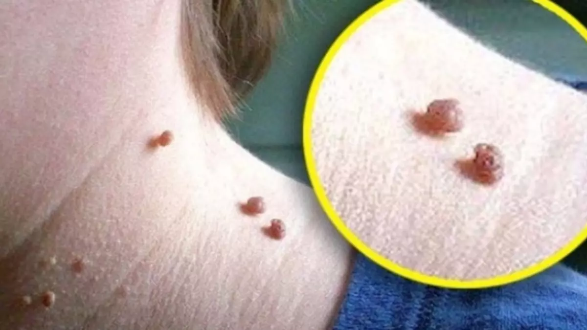 Et benleri kabusunuz olmasın! Tek bir meyveyle onlardan sonsuza dek kurtulun!