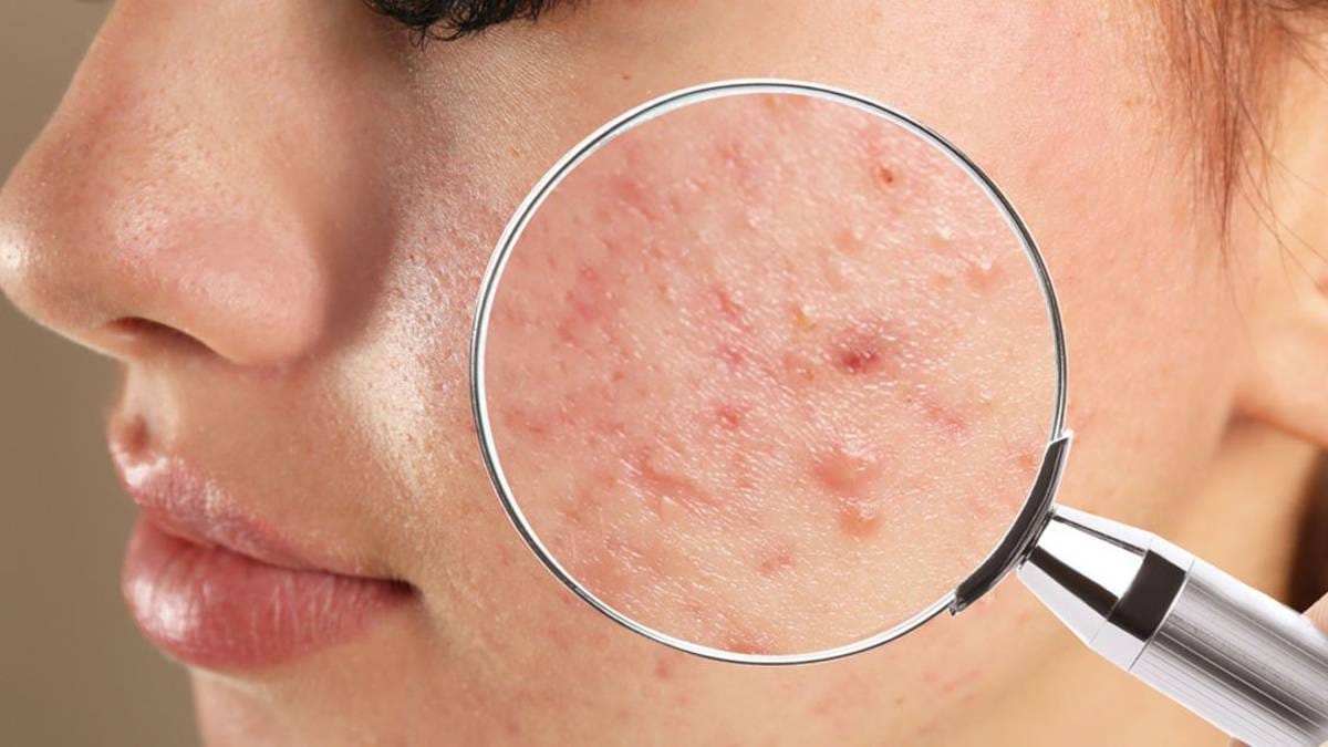 Sivilcelere, ağır kimyasallarla veda edin: Mutfaktaki tek malzemeyle akne sorununu kökten çözün!