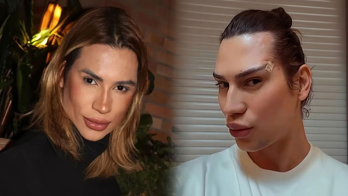 Junior Dutra kimdir ve nasıl öldü? Estetik ameliyat komplikasyonları nelerdir? Fox eyes operasyonu güvenli mi?