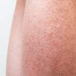 Pürüzsüz cilt hayali gerçek oluyor! Çilek bacak görünümünü tarihe gömecek kesin çözümler