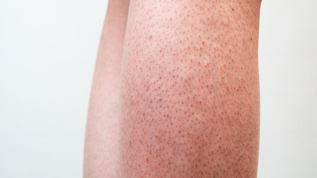 Pürüzsüz cilt hayali gerçek oluyor! Çilek bacak görünümünü tarihe gömecek kesin çözümler