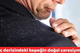 Bu iki malzemeyle kepek sorununu tarihe gömün! Üstelik hem doğal hem ekonomik