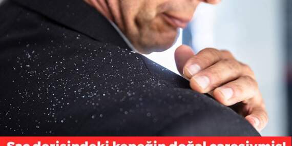 Bu iki malzemeyle kepek sorununu tarihe gömün! Üstelik hem doğal hem ekonomik