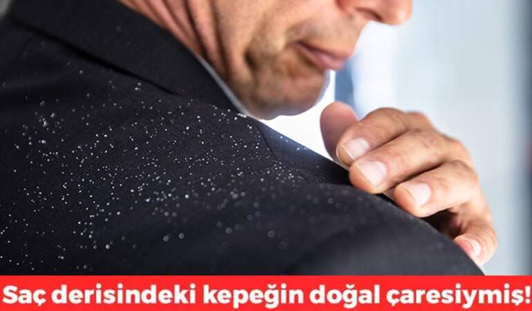 Bu iki malzemeyle kepek sorununu tarihe gömün! Üstelik hem doğal hem ekonomik