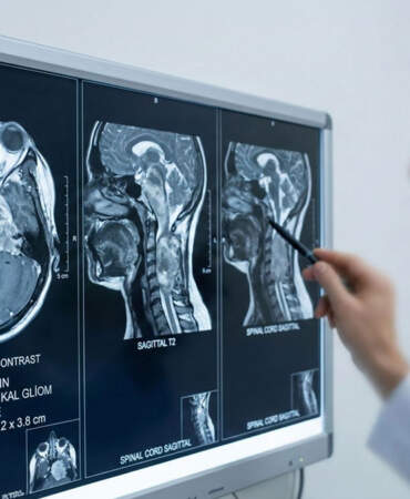 Beyin tümörü belirtileri nelerdir? Beyin kanseri nasıl fark edilir? Yolculukta başlayan görme bozukluğu tümör çıktı!