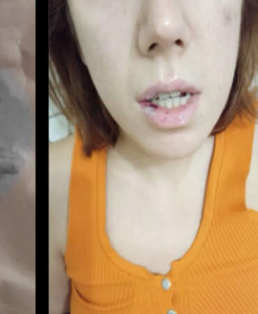 Diş ağrısıyla gitti, hayatı kabusa döndü: 29 yaşındaki genç kadın iki yıldır mama ile besleniyor