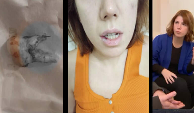 Diş ağrısıyla gitti, hayatı kabusa döndü: 29 yaşındaki genç kadın iki yıldır mama ile besleniyor