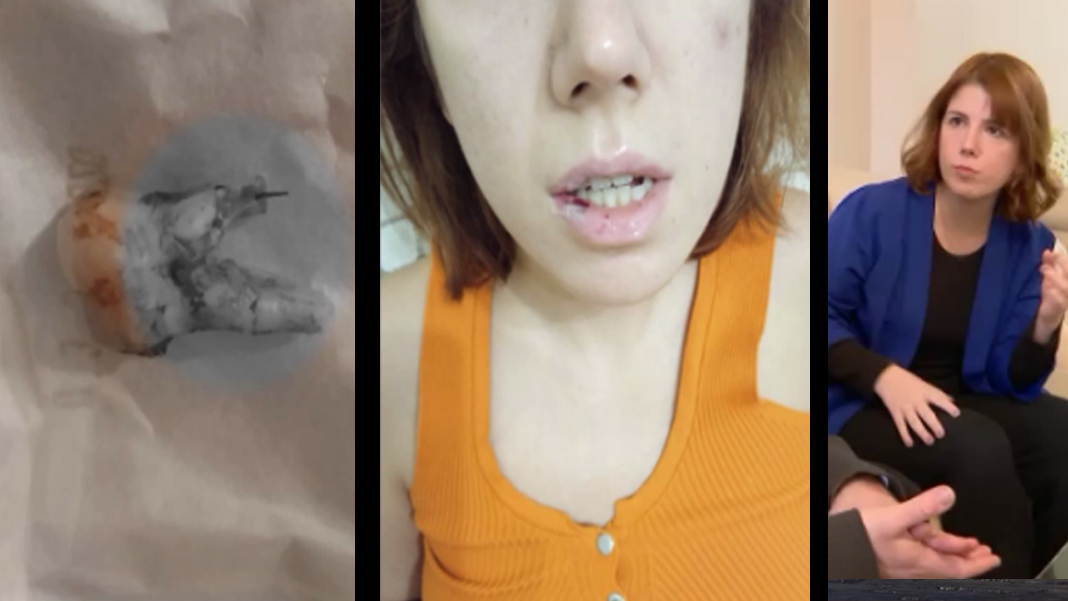 Diş ağrısıyla gitti, hayatı kabusa döndü: 29 yaşındaki genç kadın iki yıldır mama ile besleniyor