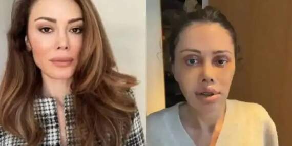 Yüz nakli yaptıran Didem Ceran’dan yeni paylaşım! ‘Harika gözüküyorum’