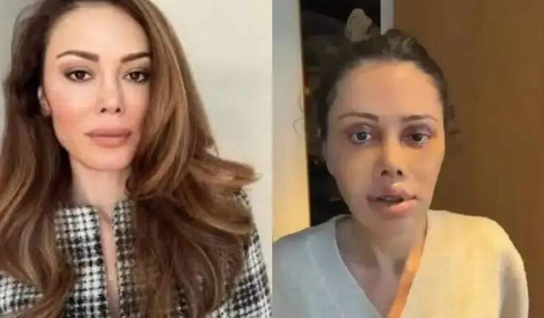 Yüz nakli yaptıran Didem Ceran’dan yeni paylaşım! ‘Harika gözüküyorum’