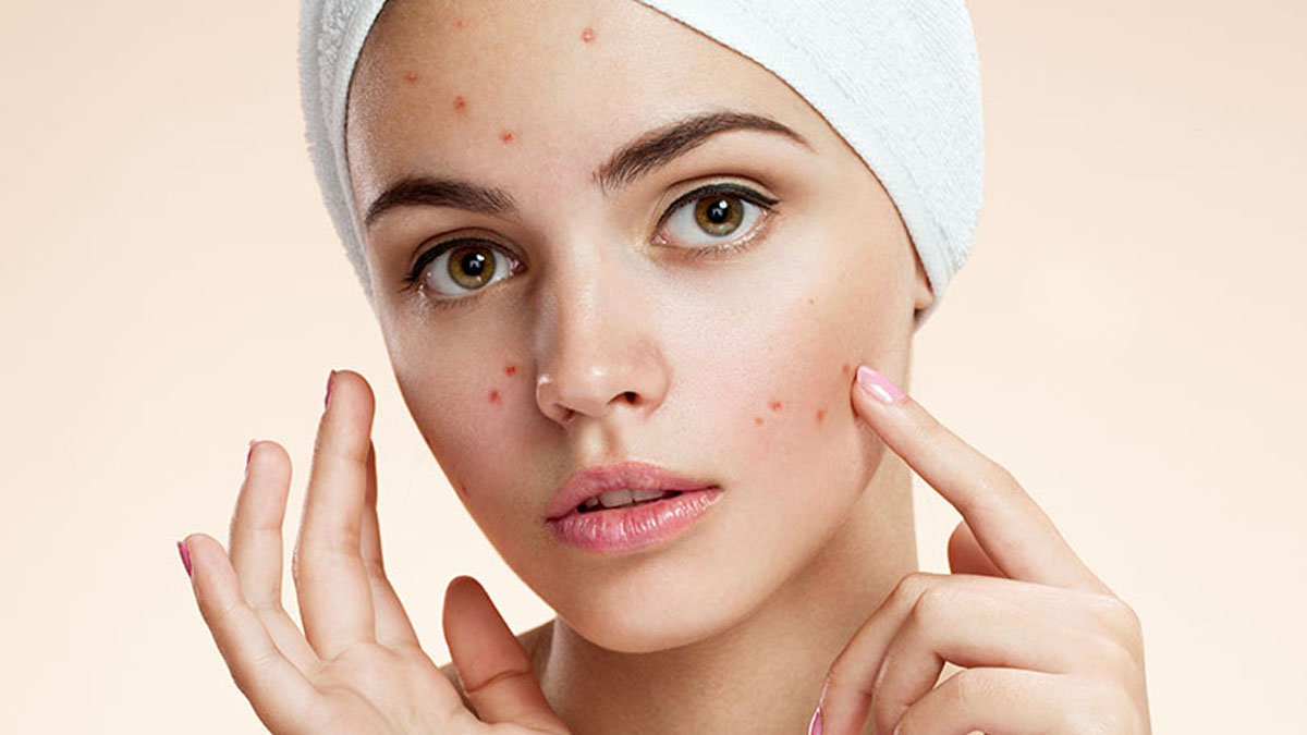 Görenler filtre var sanacak: Ciltteki yağı ve sivilceyi silip süpüren o karışım!