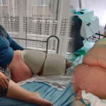 Fil hastalığı nedir, lenfödem tedavisi nasıl yapılır? Fil hastalığına ne iyi gelir? Tek bacağın ağırlığı 100 kiloya çıktı