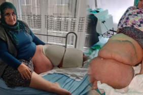 Fil hastalığı nedir, lenfödem tedavisi nasıl yapılır? Fil hastalığına ne iyi gelir? Tek bacağın ağırlığı 100 kiloya çıktı