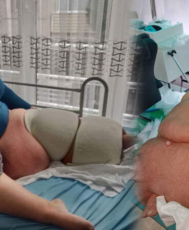 Fil hastalığı nedir, lenfödem tedavisi nasıl yapılır? Fil hastalığına ne iyi gelir? Tek bacağın ağırlığı 100 kiloya çıktı