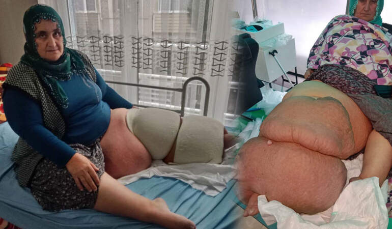 Fil hastalığı nedir, lenfödem tedavisi nasıl yapılır? Fil hastalığına ne iyi gelir? Tek bacağın ağırlığı 100 kiloya çıktı