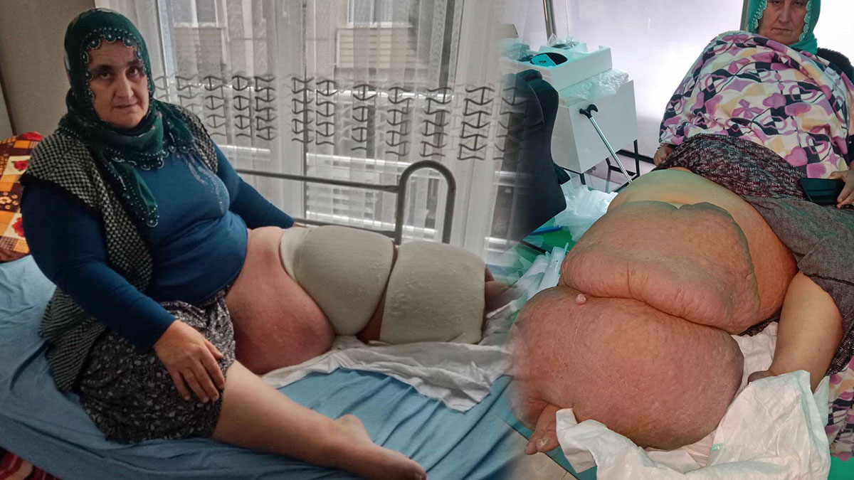 Fil hastalığı nedir, lenfödem tedavisi nasıl yapılır? Fil hastalığına ne iyi gelir? Tek bacağın ağırlığı 100 kiloya çıktı