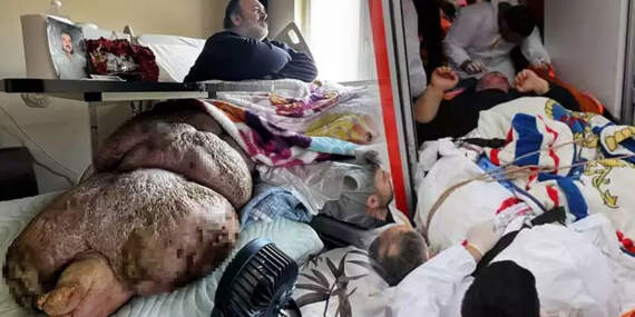 Fil hastalığı tedavisi var mı? Fil hastalığı bacak şişmesi nasıl iner? Sadece tek bacağı 130 kiloya ulaştı