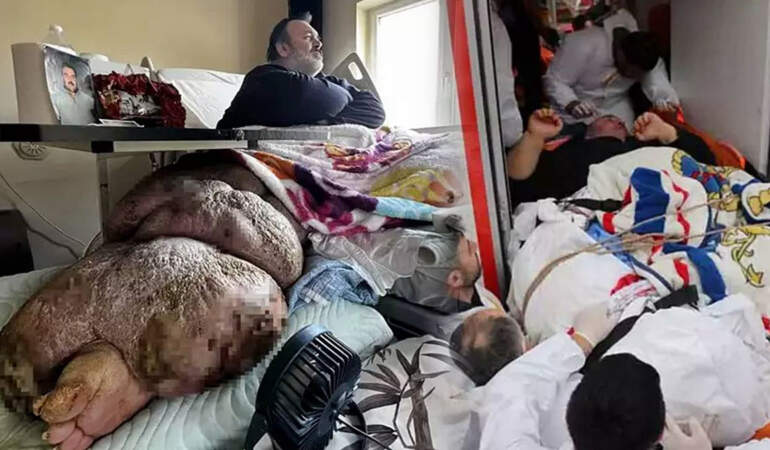 Fil hastalığı tedavisi var mı? Fil hastalığı bacak şişmesi nasıl iner? Sadece tek bacağı 130 kiloya ulaştı