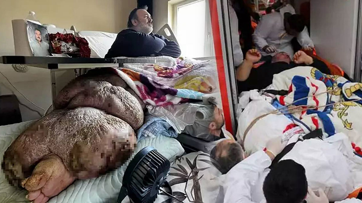 Fil hastalığı tedavisi var mı? Fil hastalığı bacak şişmesi nasıl iner? Sadece tek bacağı 130 kiloya ulaştı