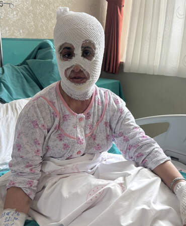 İftar hazırlığında düdüklü tencere patladı! Genç kadın ağır yaralandı: ‘Ben yandım başkası yanmasın’